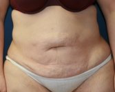 Tummy tuck san diego 76 - before