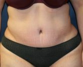 Tummy tuck san diego 76 - after