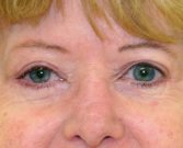Blepharoplasty Case 13 - after