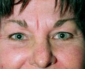 Blepharoplasty Case 14 - before