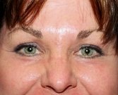Blepharoplasty Case 14 - after