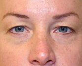 Blepharoplasty Case 15 - before
