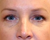 Blepharoplasty Case 15 - after