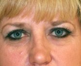 Blepharoplasty Case 16 - before