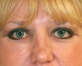 Blepharoplasty Case 16 - after