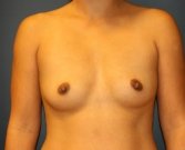 Natural Breast Augmentation San Diego 2 - before