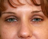 Blepharoplasty Case 17 - before