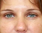 Blepharoplasty Case 17 - after