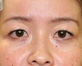 Blepharoplasty Case 18 - before