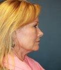 Neck and Lower Face Lift San Diego - before