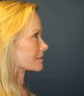 Neck and Lower Face Lift San Diego - after