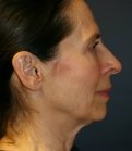 Neck and Lower Face Rejuvenation - before