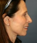 Neck and Lower Face Rejuvenation - after