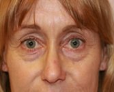 Blepharoplasty Case 19 - before