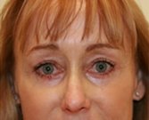 Blepharoplasty Case 19 - after