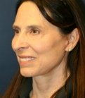 Lower Face Lift and Neck Lift - after