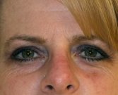 Blepharoplasty Case 20 - before