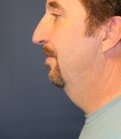 NeckLift & Chin Implant San Diego - before