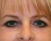 Blepharoplasty Case 20 - after