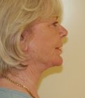 Neck and Lower Face Re-shaping - after
