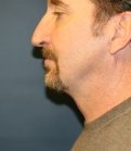Chin Implant with Neck procedure - after