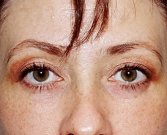 Blepharoplasty Case 21 - after