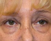Blepharoplasty Case 22 - before
