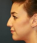 rhinoplasty san diego 52 - before