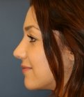 rhinoplasty san diego 52 - after