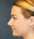 rhinoplasty san diego 53 - before