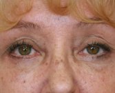 Blepharoplasty Case 22 - after