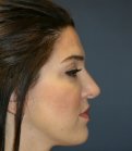 rhinoplasty san diego 55 - before