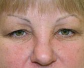 Blepharoplasty Case 24 - before