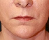 Corner of Lip Lift 138 - before