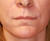 Corner of Lip Lift 138 - after