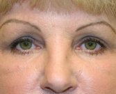 Blepharoplasty Case 24 - after