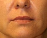 Corner of Lip Lift 140 - after