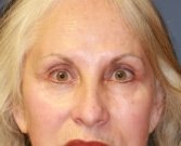 Removing grafted eyelid fat - before