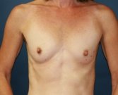 Breast Implants after five years - before