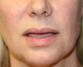 Lip Lift San Diego 142 - before