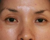 Blepharoplasty Case 23 - before