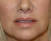 Lip Lift San Diego 142 - after