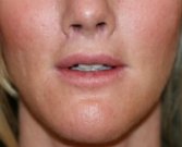 Lip Lift San Diego 141 - after