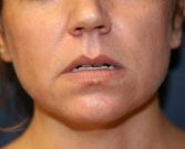 Lip Lift and Corner of Lip Lift - before