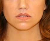 Lip Lift and Corner of Lip Lift - after