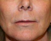 upper lip lift 145 - before