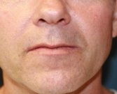 Upper Lip Lift San Diego 146 - before