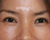 Blepharoplasty Case 23 - after