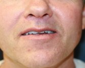 Upper Lip Lift San Diego 146 - after