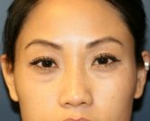 Lower eyelid bulges removal - before